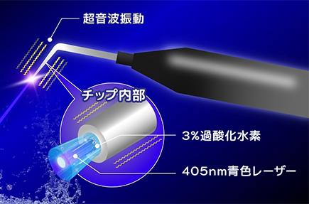 世界初の歯周病治療機「Blue Radical」